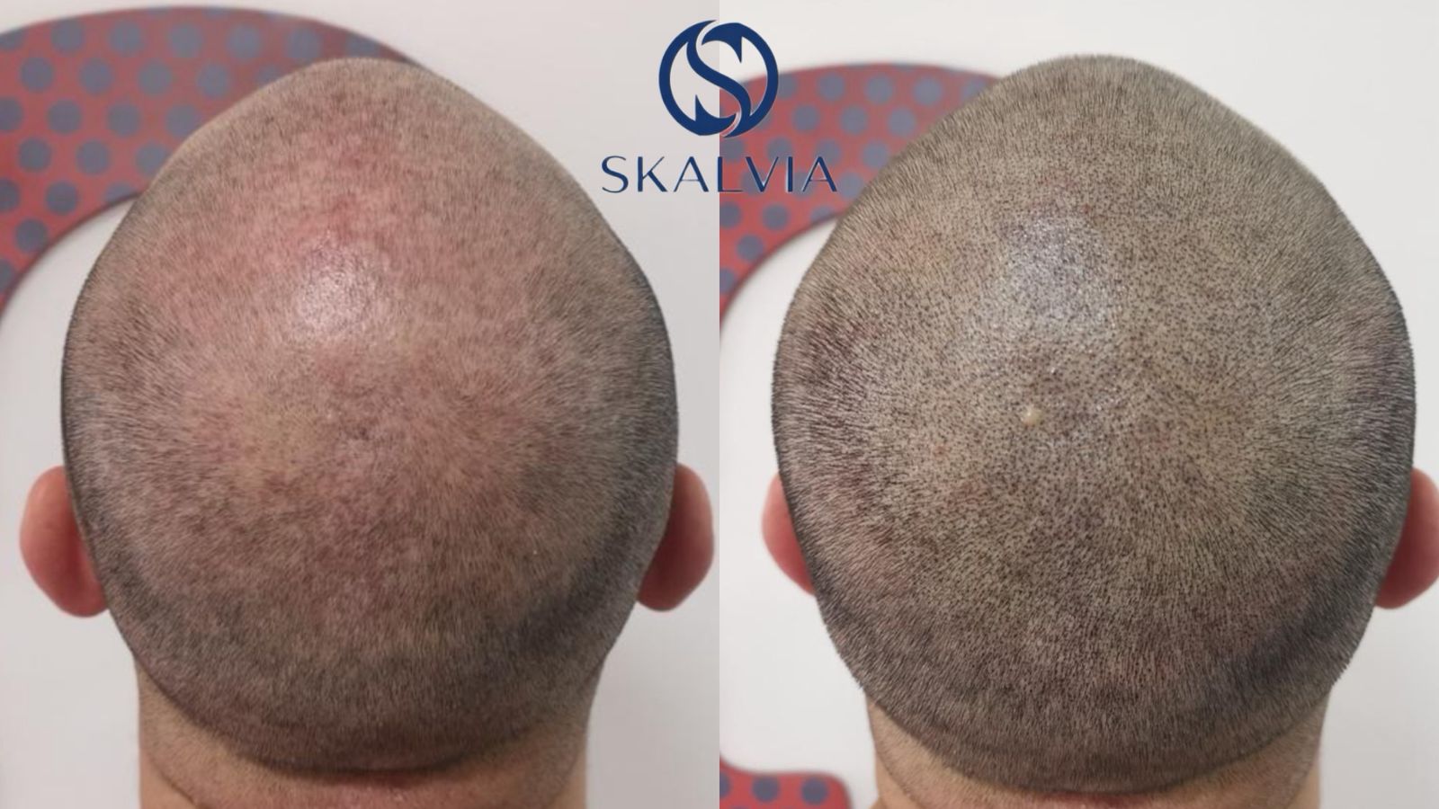 Resultado micropigmentación